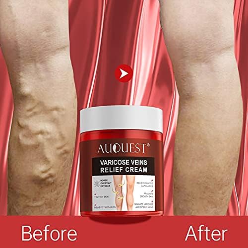 Varicose Veins Relief Cream